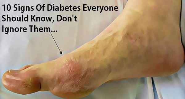 10 Signs Of Diabetes Everyone Should Know, Don’t Ignore Them – Better ...