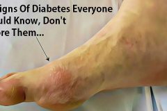 10 Signs Of Diabetes Everyone Should Know, Don’t Ignore Them