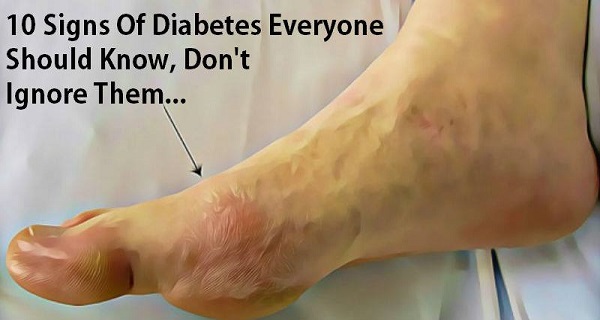 10 Signs Of Diabetes Everyone Should Know, Don’t Ignore Them