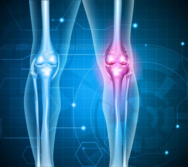 Your own blood could provide treatment for knee arthritis